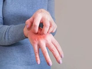 La sarna vuelve a preocupar en Barcelona: así se contagia y se detecta